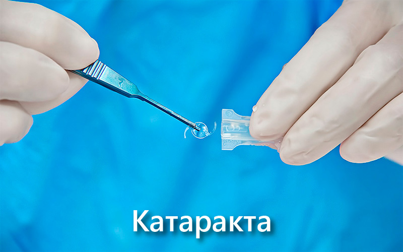 Катаракта: симптомы и лечение